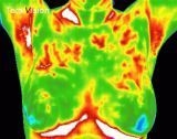 Fibrocystic.jpg